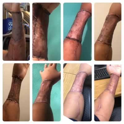 A pele para formar um “Neo-pênis” é retirada da perna ou do braço.