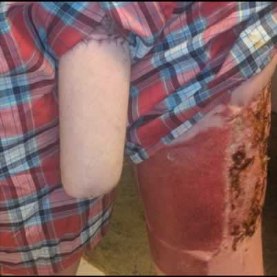 A pele para formar um “Neo-pênis” é retirada da perna ou do braço.