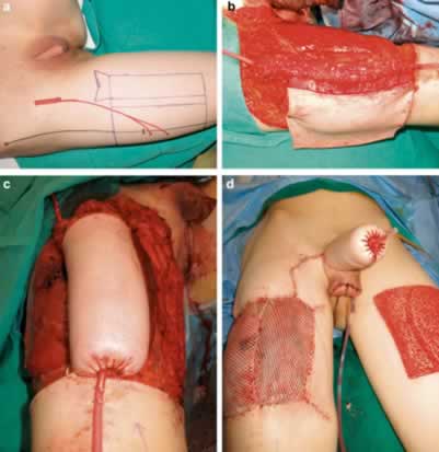 A pele para formar um “Neo-pênis” é retirada da perna ou do braço.