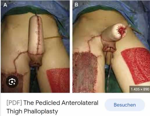 A pele para formar um “Neo-pênis” é retirada da perna ou do braço.