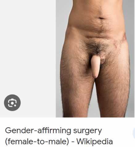 A pele para formar um “Neo-pênis” é retirada da perna ou do braço.