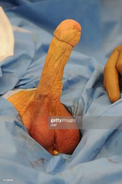 A pele para formar um “Neo-pênis” é retirada da perna ou do braço.