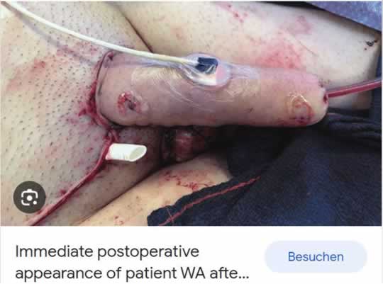 Cirurgia de redesignação de gênero é uma automutilação genital baseada no engano 21