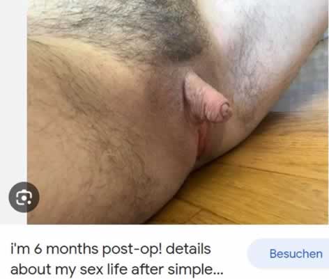 Na Metoidioplastia o “Neo-pênis” é construído a partir do clitóris aumentado, o que é conseguido através da terapia de reposição hormonal.