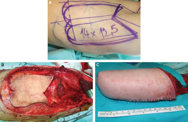 A pele para formar um “Neo-pênis” é retirada da perna ou do braço.