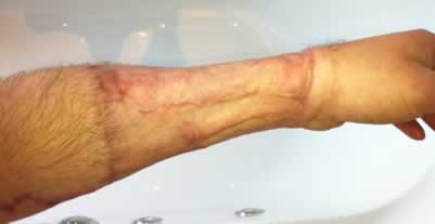 A pele para formar um “Neo-pênis” é retirada da perna ou do braço.