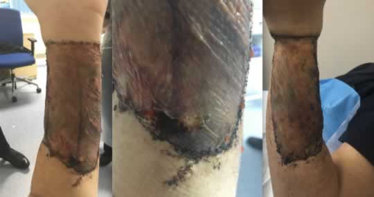 A pele para formar um “Neo-pênis” é retirada da perna ou do braço.