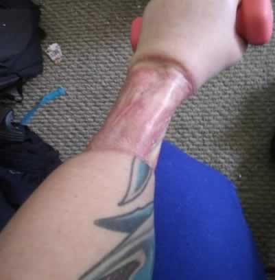 A pele para formar um “Neo-pênis” é retirada da perna ou do braço.