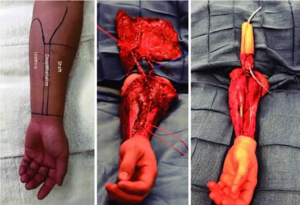 A pele para formar um “Neo-pênis” é retirada da perna ou do braço.