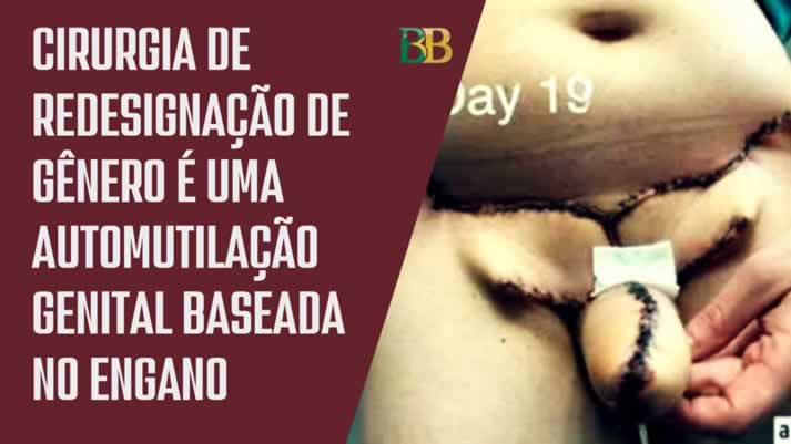 O “Neo-pênis” é feito com pele retirada da perna ou do braço.Cirurgia de redesignação de gênero é uma automutilação genital baseada no engano